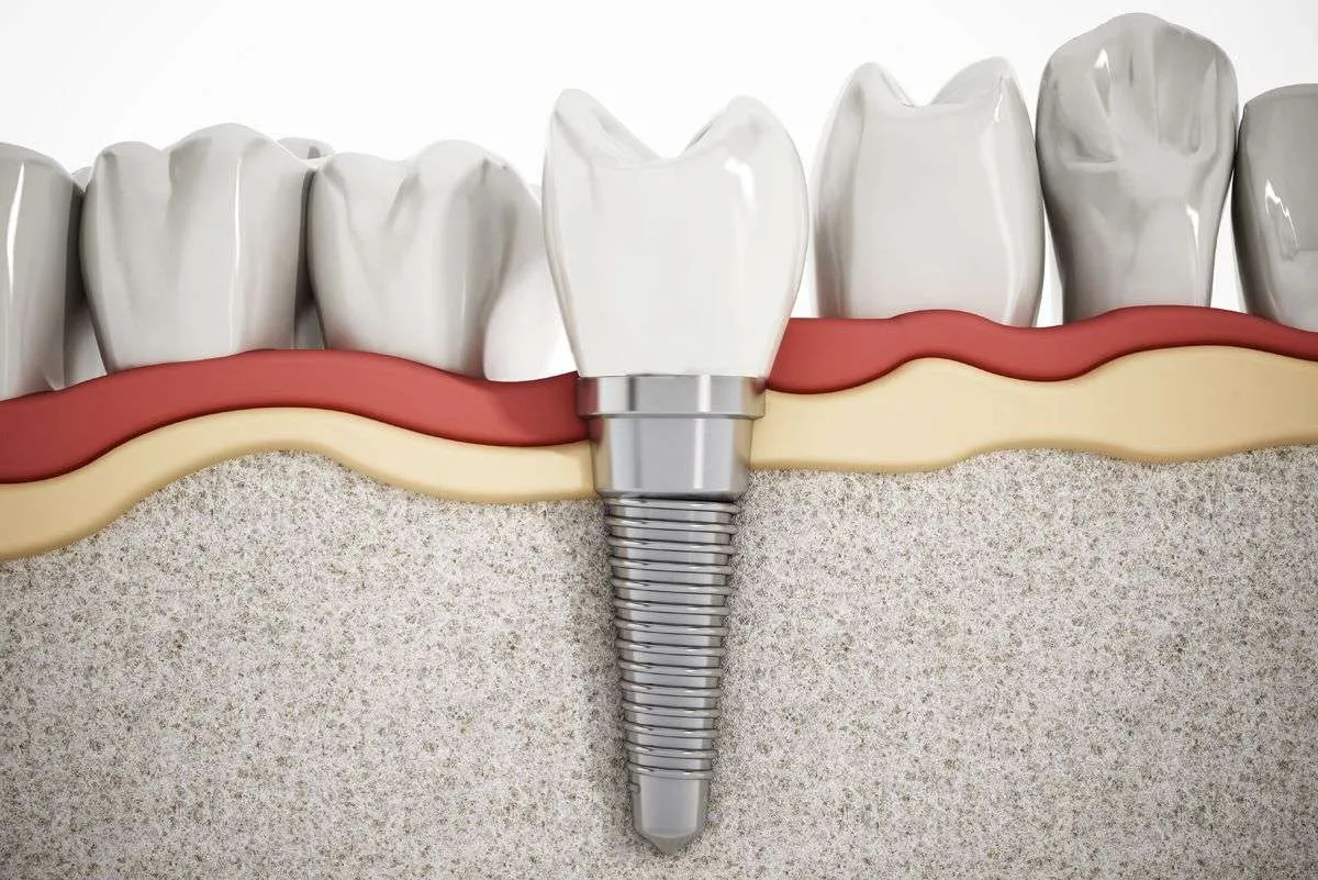 Qué tipos de implantes dentales existen