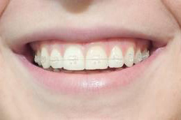 brackets-ceramicos-dentisalut-ortodoncia