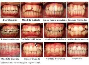 Ortodoncia, tipos de correciones