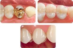 Incrustación dental metálica