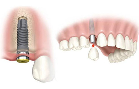 Implantes dentales Barcelona: técnica de carga inmediata Implantes dentales Barcelona: técnica de carga inmediata