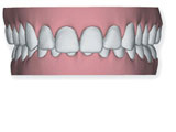 Sobremordida