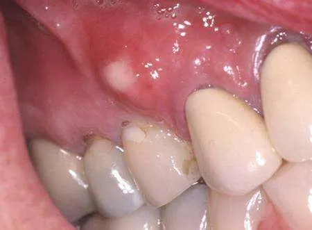 fistula gums