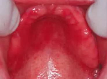 Candidiasis bucal6