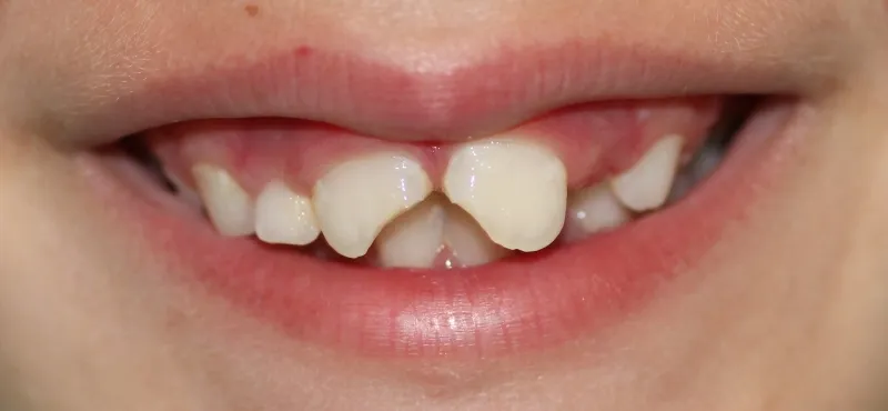 traumatismo dental2
