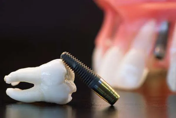 Los Implantes En Los Molares Dentisalut 6528