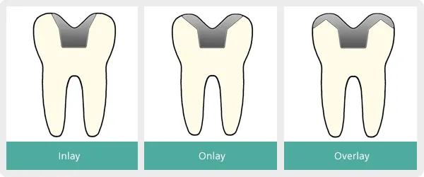 Inlay onlay overlay. Inlay onlay overlay. Вкладка инлей стоматология. Инлей онлей оверлей. Инлэй вкладка стоматология.