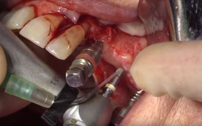 [VIDEO] Cirugía de Expansión osea con colocación de implantes y uso de plasma rico en fibrina