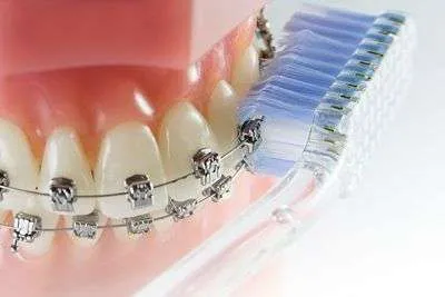 Cómo cepillarse los dientes con brackets