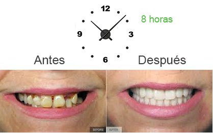 Beneficios de la técnica All on 4 Beneficios de la técnica All on 4