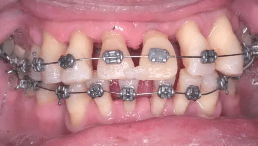 La Enfermedad Periodontal Y El Tratamiento De Ortodoncia - Dentisalut