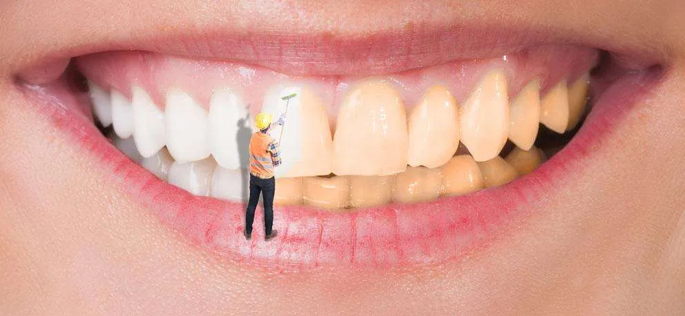¿Se puede blanquear una funda sobre implantes? ¿Se puede blanquear una funda sobre implantes?