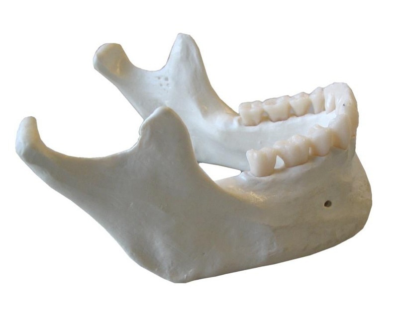 Osteoradionecrosis en maxilar y mandíbula