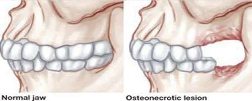Osteoradionecrosis en maxilar y mandíbula
