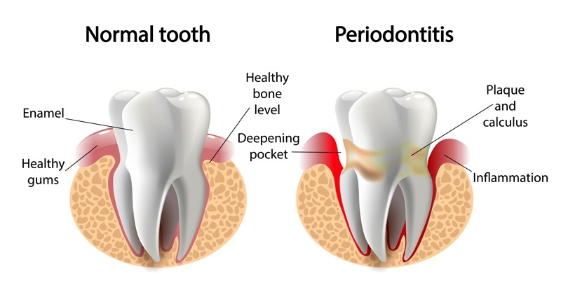 TODO SOBRE EL TRATAMIENTO PERIODONTAL TODO SOBRE EL TRATAMIENTO PERIODONTAL