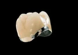 Corona dental metalo–cerámica (metalo– porcelana)