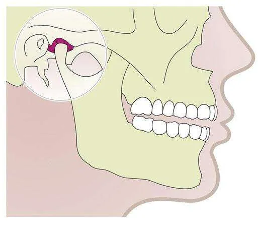 Enfermedades de la articulación temporo mandibular (ATM)