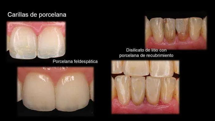 Porcelana feldespatica Porcelana feldespatica