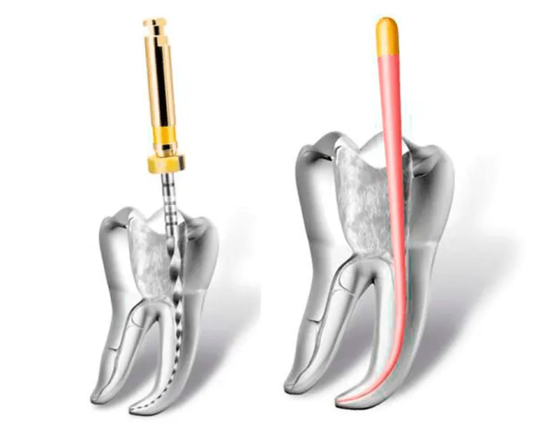 Técnicas de instrumentación en endodoncia Dentisalut