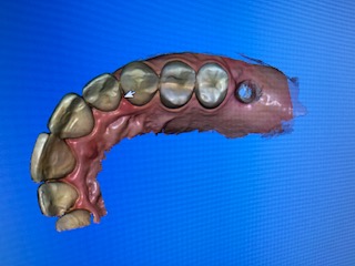 Paso 1 Sistema Cerec Paso 1 Sistema Cerec