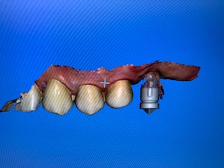 Paso 2 Sistema Cerec Paso 2 Sistema Cerec