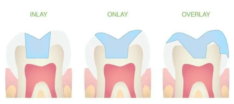 Diferencia Entre Una Corona Y Una Incrustacion Dental Dentisalut