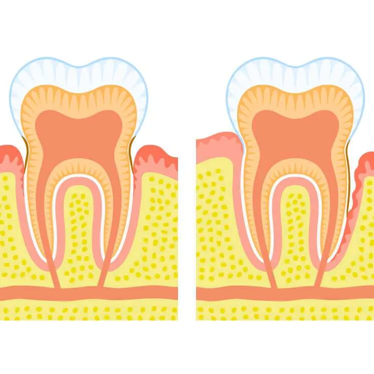 Periodontitis y diabetis Periodontitis y diabetis