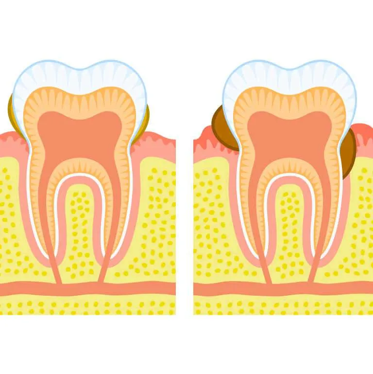 Periodontitis y diabetis Periodontitis y diabetis