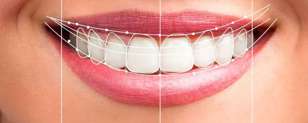 Carillas dentales ¿Qué son? ¿Cuál es su función? - MYCA Clínica Dental