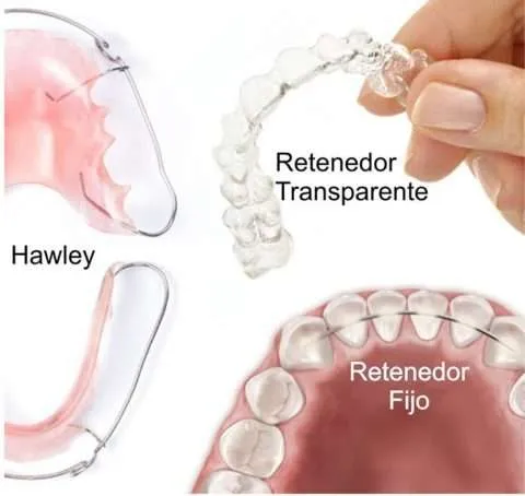 Brackets Invisibles Es Lo Mismo Que Invisalign Dentisalut