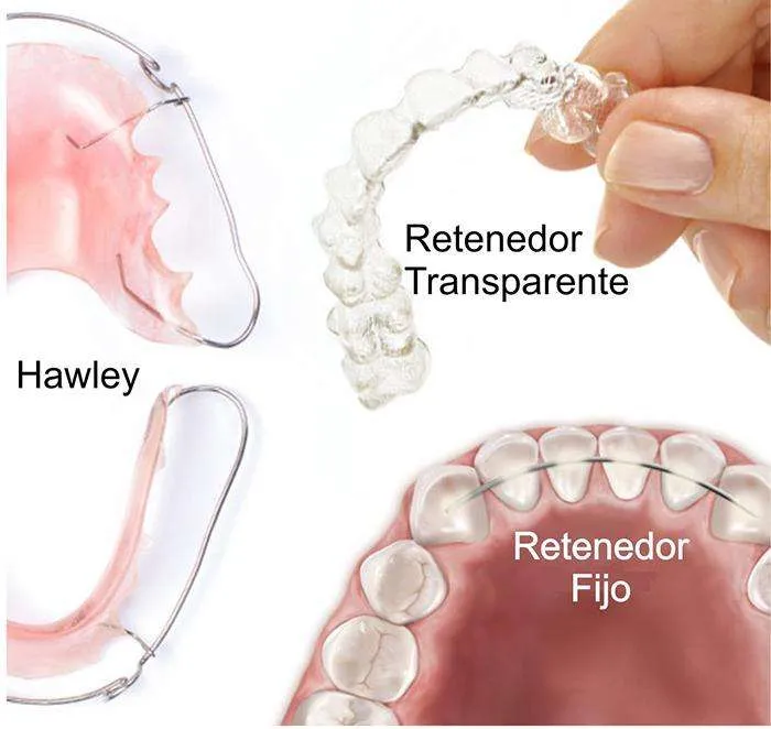 Tipos de retenedores dentales