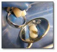 ¿Cómo se realiza el proceso de una incrustación dental?