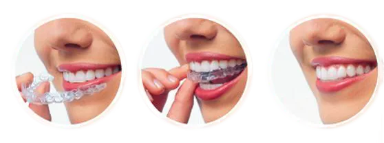 INVISALIGNB-PROCESO