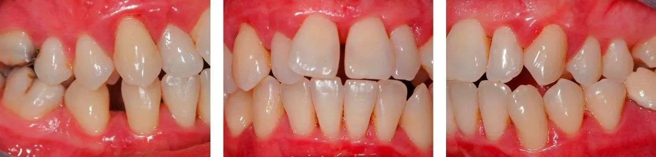 Antes y después tratamiento periodontal Antes y después tratamiento periodontal