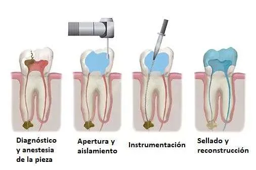 Proceso y evolución endodoncia