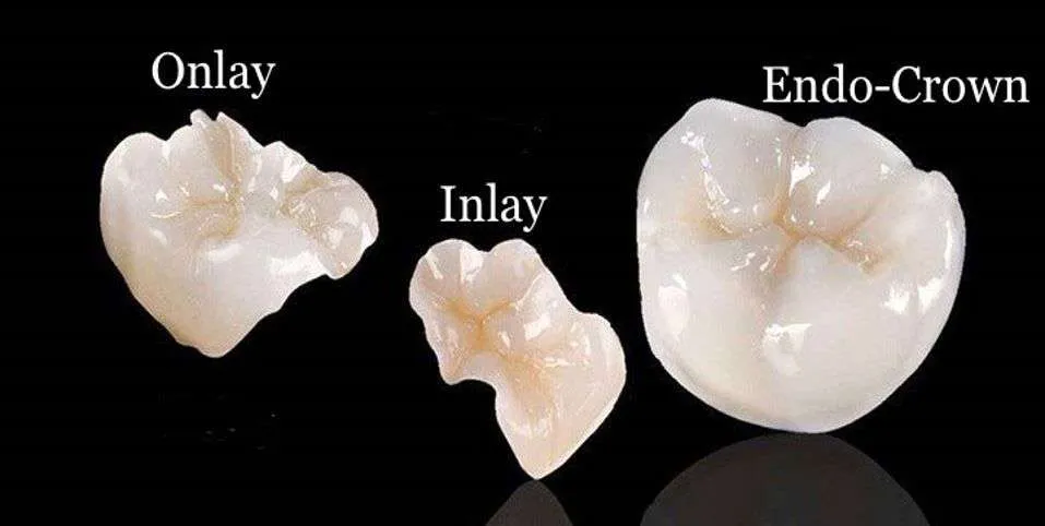 Incrustaciones dentales Incrustaciones dentales