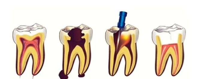 Proceso endodoncia Proceso endodoncia
