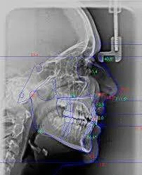 Radiografía lateral del cráneo o cefalometría