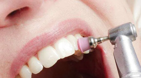 Blanqueamiento dental Blanqueamiento dental