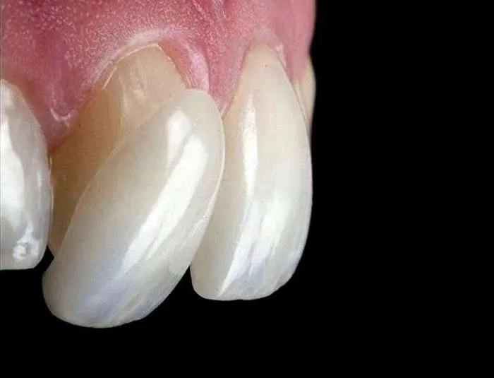 Carillas dentales Carillas dentales