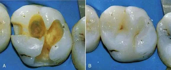 reconstrucción dental con composite reconstrucción dental con composite