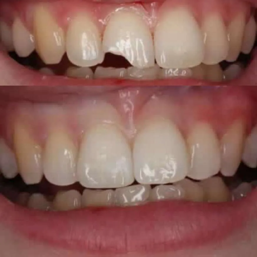 Mejor opción para reconstruir una pieza dental Mejor opción para reconstruir una pieza dental