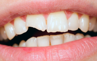 ¿Qué es la reconstrucción dental?