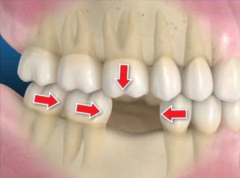 consecuencias de la falta de dientes