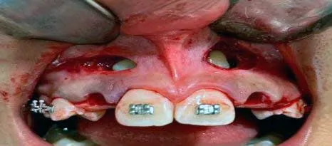 articulo colutorio dentisalut3