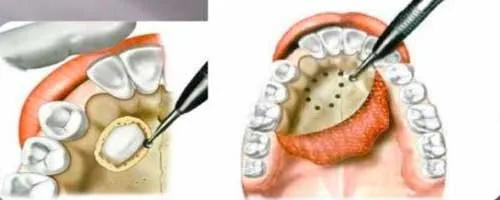 articulo colutorio dentisalut3