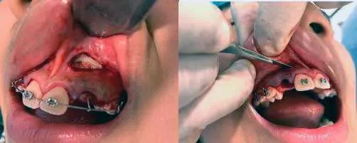 articulo colutorio dentisalut3