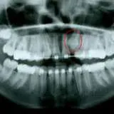 implantes dentales carga inmediata