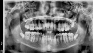 articulo colutorio dentisalut3
