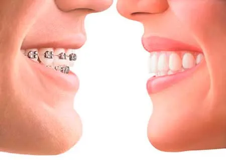 Invisalign o brackets Invisalign o brackets
